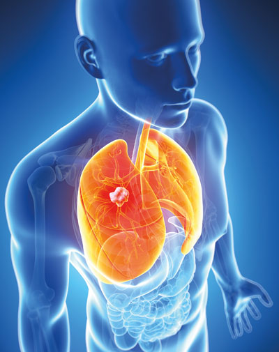 Lungenkrebs (schematische Darstellung) 