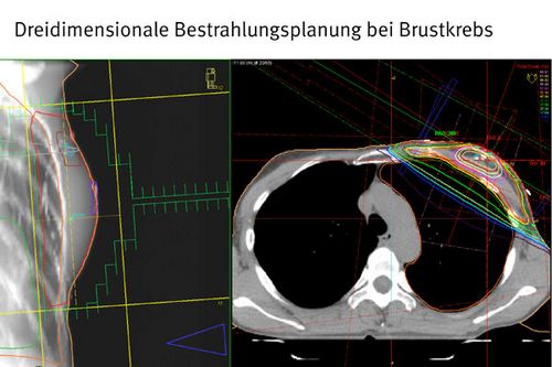 3D-Bestrahlungsplanung bei Brustkrebs