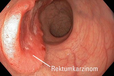 Endoskopische Aufnahme eines Tumors am Mast- oder Enddarm (Rektumkarzinom)