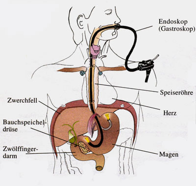 Schematische Darstellung der Gastroskopie