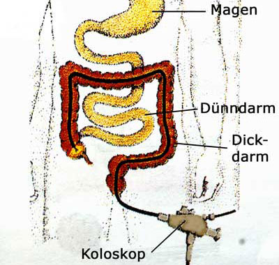 Schematische Darstellung der Koloskopie