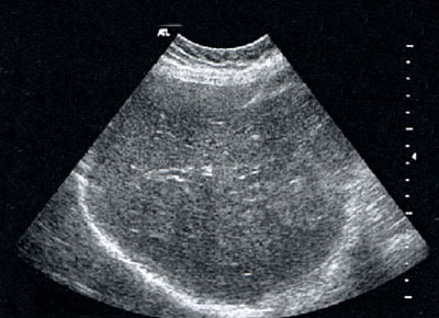Ultraschalluntersuchung der Leber ohne Kontrastmittel
