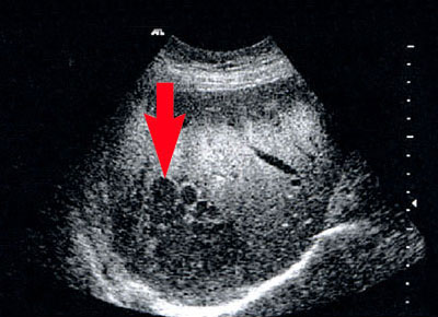 Ultraschalluntersuchung der Leber mit Kontrastmittel