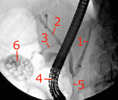 ERCP-Aufnahme bei Patient mit Gallensteinleiden