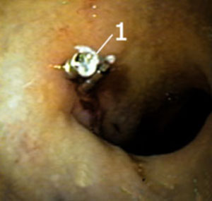 Endoskopische Aufnahme eines mit Metallclips abgeklemmten Magengeschwürs