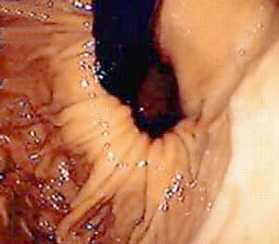 Endoskopische Aufnahme eines Zwerchfellbruchs (Hiatushernie)