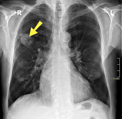 Lungentumor (Bronchialkarzinom) im Röntgenbild