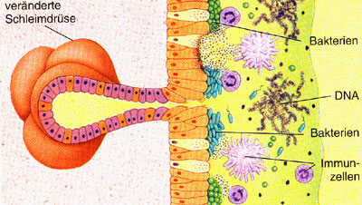 Schematische Darstellung der Mukoviszidose