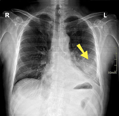 Röntgenaufnahme einer Lungenentzündung