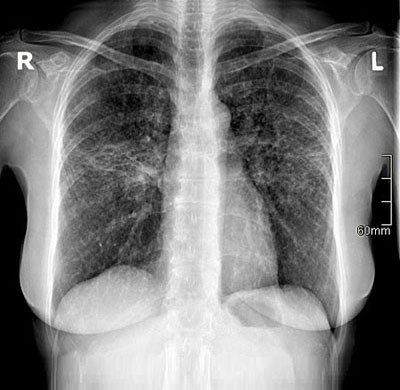 Sarkoidose im Röntgenbild