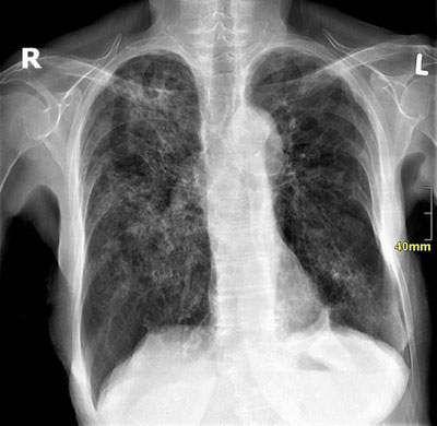 Lungentuberkulose im Röntgenbild