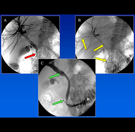 Patient mit Gallengangsverschluss (CT-Aufnahme)