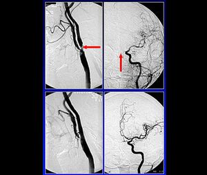 Behandlung einer hochgradigen Einengung der gehirnversorgenden Arterie Behandlung einer hochgradigen Einengung der gehirnversorgenden Arterie
