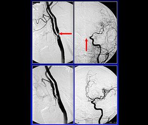 Behandlung einer hochgradigen Einengung der gehirnversorgenden Arterie