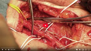 Video: Operative Therapie der arteriellen Verschlusskrankheit (Schaufensterkrankheit)