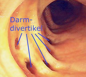 Endoskopische Aufnahme einer Divertikulose