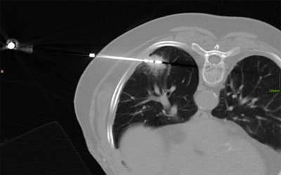 Mikrowellenantenne in einer Lungenmetastase (computertomografische Aufnahme) Mikrowellenantenne in einer Lungenmetastase (computertomografische Aufnahme)