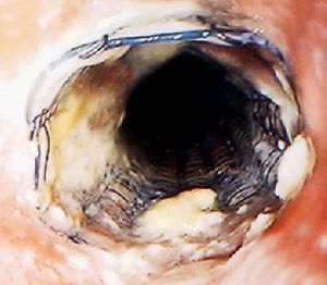 Drahtgitterprothese (Stent) bei fortgeschrittenem Ösophaguskarzinom