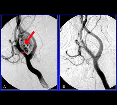 Gefäßtumor am Hals (CT-Aufnahme)