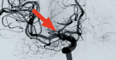 Mittlere Hirnarterie nach Beseitigung des Blutgerinnsels (angiografische Aufnahme) Mittlere Hirnarterie nach Beseitigung des Blutgerinnsels (angiografische Aufnahme)