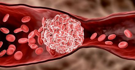 Bei einer Thrombose bildet sich ein Blutgerinnsel (Mitte) in einem Blutgefäß oder im Herzen (Bild: shutterstock.com/MattLphotography) Bei einer Thrombose bildet sich ein Blutgerinnsel (Mitte) in einem Blutgefäß oder im Herzen (Bild: shutterstock.com/MattLphotography)