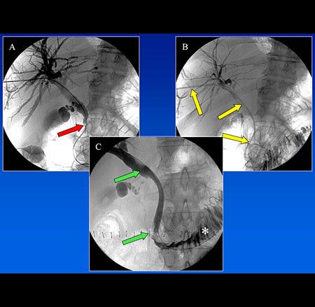 Patient mit Gallengangsverschluss (CT-Aufnahme) Patient mit Gallengangsverschluss (CT-Aufnahme)