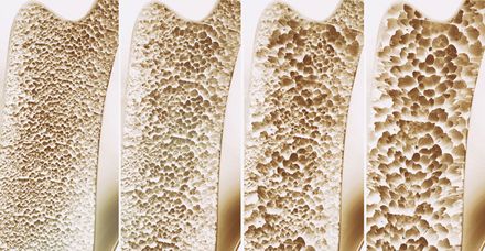 Die vier Stufen der Osteoporose: Mit zunehmender Osteoporose verliert der Knochen immer mehr an Dichte und Stabilität (Bild: shutterstock.com/Crevis) Die vier Stufen der Osteoporose: Mit zunehmender Osteoporose verliert der Knochen immer mehr an Dichte und Stabilität (Bild: shutterstock.com/Crevis)