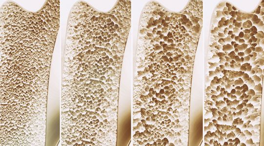 Die vier Stufen der Osteoporose: Mit zunehmender Osteoporose verliert der Knochen immer mehr an Dichte und Stabilit&auml;t (Bild: shutterstock.com/Crevis)