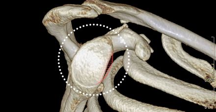 Aufnahme vor der OP: eine durch häufiges Auskugeln abgeschliffene Gelenkpfanne (rot straffierte Zone) Aufnahme vor der OP: eine durch häufiges Auskugeln abgeschliffene Gelenkpfanne (rot straffierte Zone)