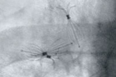 Röntgenaufnahme von in die Bronchien eingesetzten Ventilen