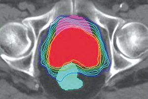 Intensitätsmodulierte Strahlentherapie (IMRT) bei Prostatakarzinom