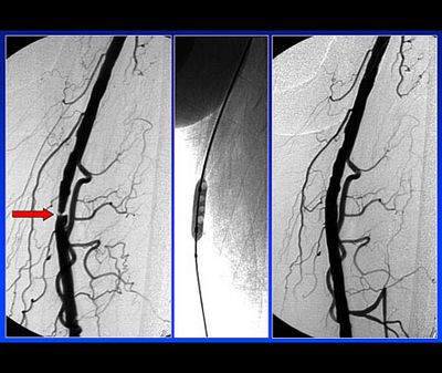 Patient mit peripher arterieller Verschlusskrankheit (= Schaufensterkrankheit)