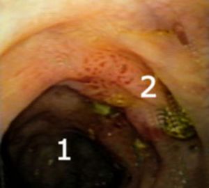 Endoskopische Aufnahme einer Divertikulitis