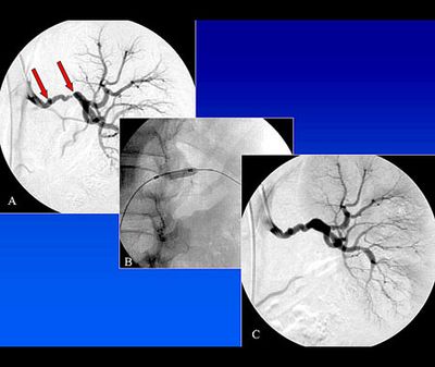 Einengung der Nierenschlagader aufgrund einer fibromuskulären Dysplasie