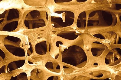 Im höheren Alter sind viele Menschen von Knochenschwund (Osteoporose) betroffen