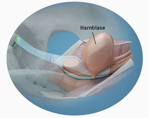 Durch eine laparoskopische Senkungsoperation lassen sich die betroffenen Organe mithilfe von Bändern oder Netzen wieder anheben und stützen (Quelle: www.ami.at)