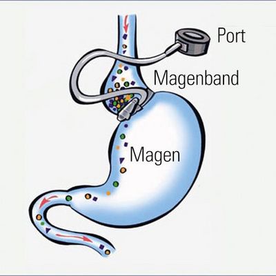 Schematische Darstellung eines Magenbands