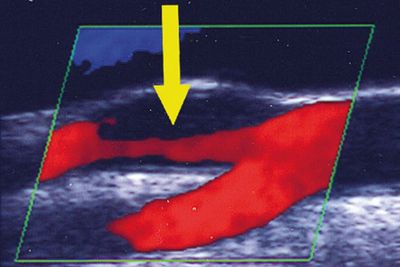 Ultraschalluntersuchung im neurosonologischen Labor