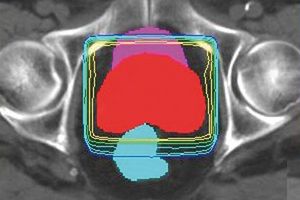 Herkömmliche dreidimensionale Bestrahlungstechnik bei Prostatakarzinom