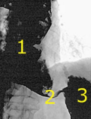 Achalasie der Speiseröhre in einer Röntgenaufnahme