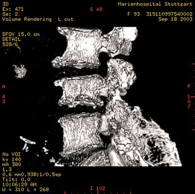 Dreidimensionale CT-Aufnahme einer Osteoporose der Wirbelsäule