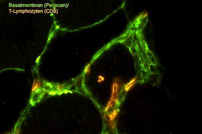 Elektronenmikroskopische Aufnahme einer Polymyositis