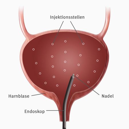 Bei der Botox-Therapie werden durch ein Endoskop mehrere kleine Injektionen von Botulinumtoxin in den Blasenmuskel gesetzt (Bild: Christine Gerhardt) Bei der Botox-Therapie werden durch ein Endoskop mehrere kleine Injektionen von Botulinumtoxin in den Blasenmuskel gesetzt (Bild: Christine Gerhardt)
