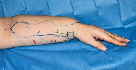 Vor der Operation werden auf der Haut des jeweiligen  Patienten die noch intakten Lymphgefäße eingezeichnet