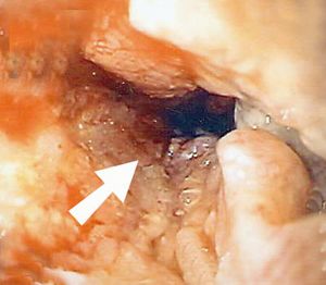 Endoskopische Aufnahme eines Ösophagus-Plattenepithelkarzinoms