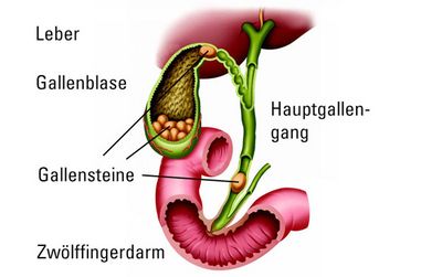 Schematische Darstellung der Gallenblase mit Gallensteinen