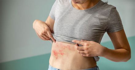Hautbläschen und Juckreiz gelten als typische Symptome der Gürtelrose, die chronische Nervenschmerzen verursachen kann