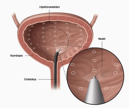 Bei der Botox-Therapie werden durch ein Endoskop mehrere kleine Injektionen von Botulinumtoxin in den Blasenmuskel gesetzt (Bild: gurology.com.au)