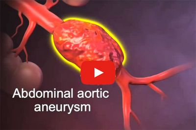 Animation zur endovaskulären OP bei Aortenaneurysma