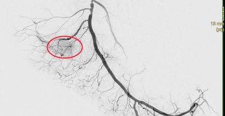 Röntgenbild vor dem Eingriff (Embolisation): Es zeigt sich eine vermehrte Gefäßneubildung im Bereich der schmerzhaften Plantarfaszie Röntgenbild vor dem Eingriff (Embolisation): Es zeigt sich eine vermehrte Gefäßneubildung im Bereich der schmerzhaften Plantarfaszie